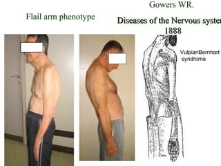 Gowers WR.
Diseases of the Nervous systemDiseases of the Nervous system
18881888
Flail arm phenotype
VulpianBernhart
syndrome