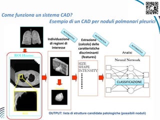10OUTPUT: lista di strutture candidate patologiche (possibili noduli)
Come funziona un sistema CAD?
Esempio di un CAD per noduli polmonari pleurici
Estrazione
(calcolo) delle
caratteristiche
discriminanti
(features)
Individuazione
di regioni di
interesse
CLASSIFICAZIONE
 