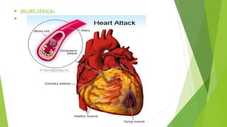  HEART ATTACK.

 