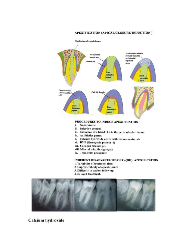 management of non vital open apex roots/ orthodontic course by indian dental academy