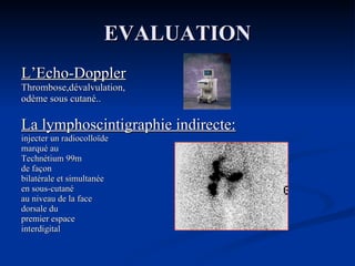 EVALUATION L’Echo-Doppler Thrombose,dévalvulation,  odème sous cutané.. La lymphoscintigraphie indirecte: injecter un radiocolloïde  marqué au Technétium 99m  de façon  bilatérale et simultanée  en sous-cutané  au niveau de la face  dorsale du premier espace  interdigital 