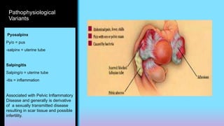 Pathophysiological
Variants
Pyosalpinx
Py/o = pus
-salpinx = uterine tube
Salpingitis
Salping/o = uterine tube
-itis = inflammation
Associated with Pelvic Inflammatory
Disease and generally is derivative
of a sexually transmitted disease
resulting in scar tissue and possible
infertility.
 