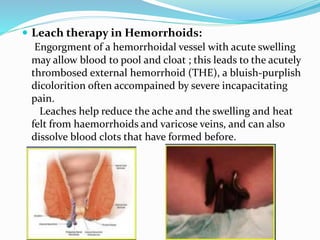  Leach therapy in Hemorrhoids:
Engorgment of a hemorrhoidal vessel with acute swelling
may allow blood to pool and cloat ; this leads to the acutely
thrombosed external hemorrhoid (THE), a bluish-purplish
dicolorition often accompained by severe incapacitating
pain.
Leaches help reduce the ache and the swelling and heat
felt from haemorrhoids and varicose veins, and can also
dissolve blood clots that have formed before.
 