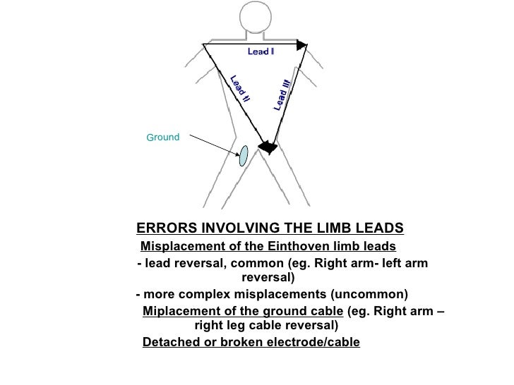 Lead errors introduction