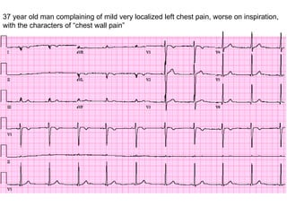 37 year old man complaining of mild very localized left chest pain, worse on inspiration, with the characters of “chest wall pain” 