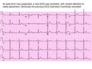 As lead error was suspected, a new ECG was recorded, with careful attention to cable placement. Obviously the previous ECG had been incorrectly recorded! 