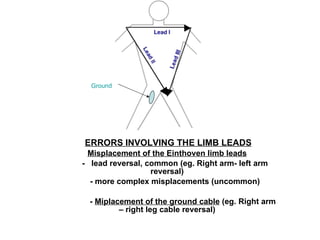 ERRORS INVOLVING THE LIMB LEADS Misplacement of the Einthoven limb leads -  lead reversal, common (eg. Right arm- left arm reversal) - more complex misplacements (uncommon) -  Miplacement of the ground cable  (eg. Right arm – right leg cable reversal) Ground 