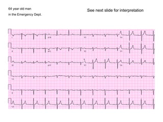 64 year old man in the Emergency Dept. See next slide for interpretation 