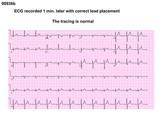 00936b  ECG recorded 1 min. later with correct lead placement The tracing is normal 