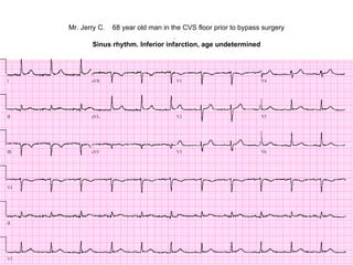 Mr. Jerry C.   68 year old man in the CVS floor prior to bypass surgery .  Sinus rhythm. Inferior infarction, age undetermined 