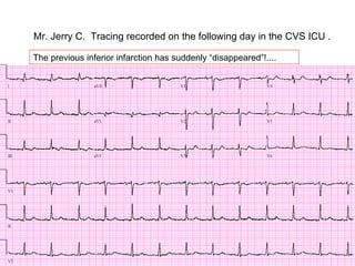 Mr. Jerry C.  Tracing recorded on the following day in the CVS ICU . The previous inferior infarction has suddenly “disappeared”!.... 