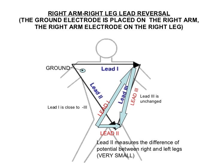 Lead errors reversal of limb leads