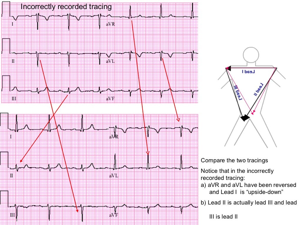 Lead errors reversal of limb leads