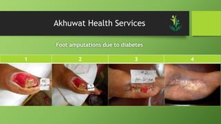Akhuwat Health Services
Foot amputations due to diabetes
1 2 3 4
 