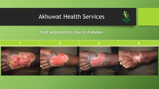 Akhuwat Health Services
Foot amputations due to diabetes
1 2 3 4
 