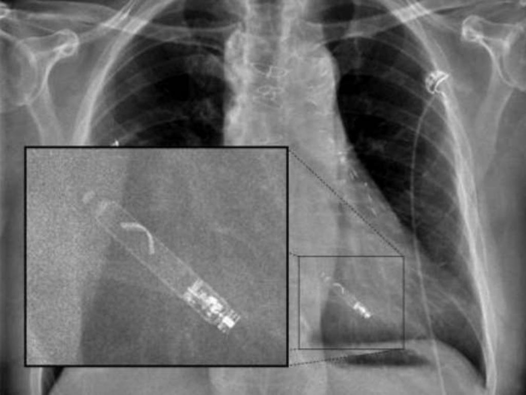 Leadless Pacemaker leadless-pacemaker