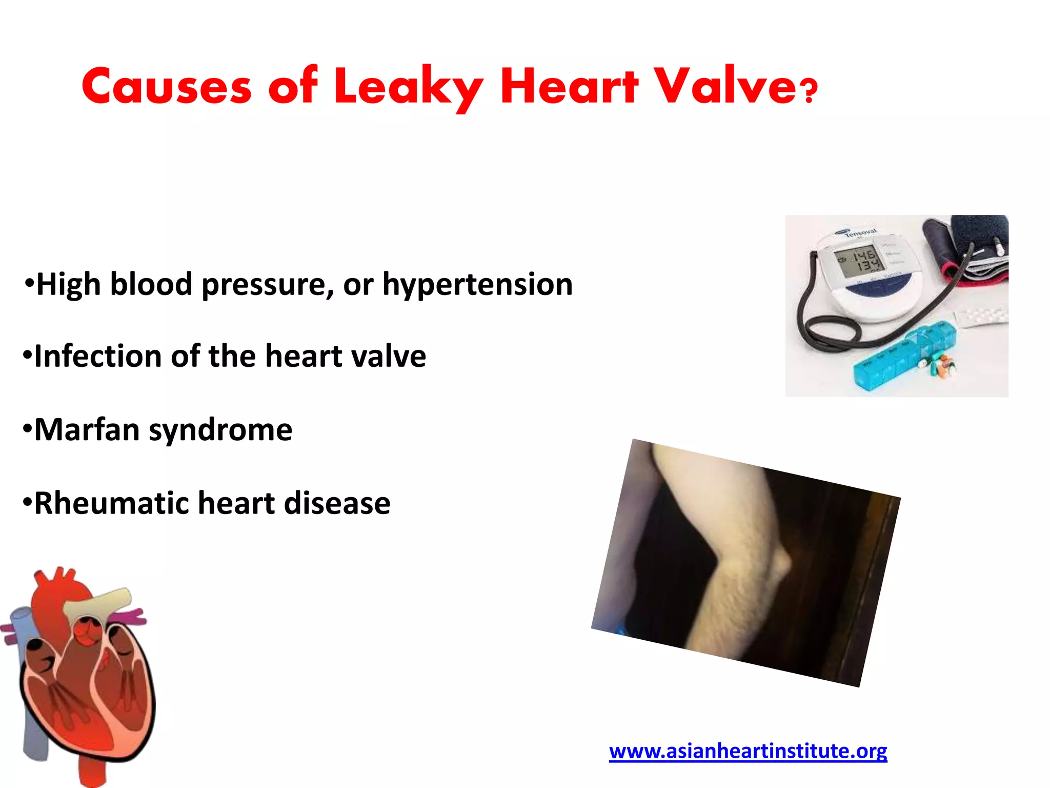 Asian Heart Institute Leaky heart valve symptoms PPT