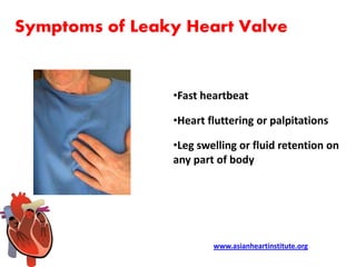 Asian Heart Institute - Leaky heart valve symptoms | PPT