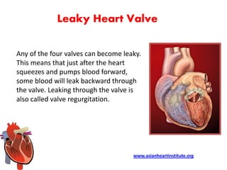 Asian Heart Institute - Leaky heart valve symptoms | PPTX