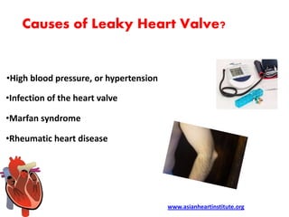 Asian Heart Institute - Leaky heart valve symptoms | PPTX