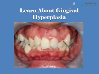 Learn About Gingival
Hyperplasia
 