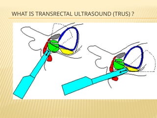 Trus Urology Example Learn About Prostate and its anatomy .pptx