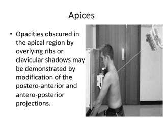 Learn Chest X-Ray With Its Normal Positioning & Radio-Anatomy | PPTX