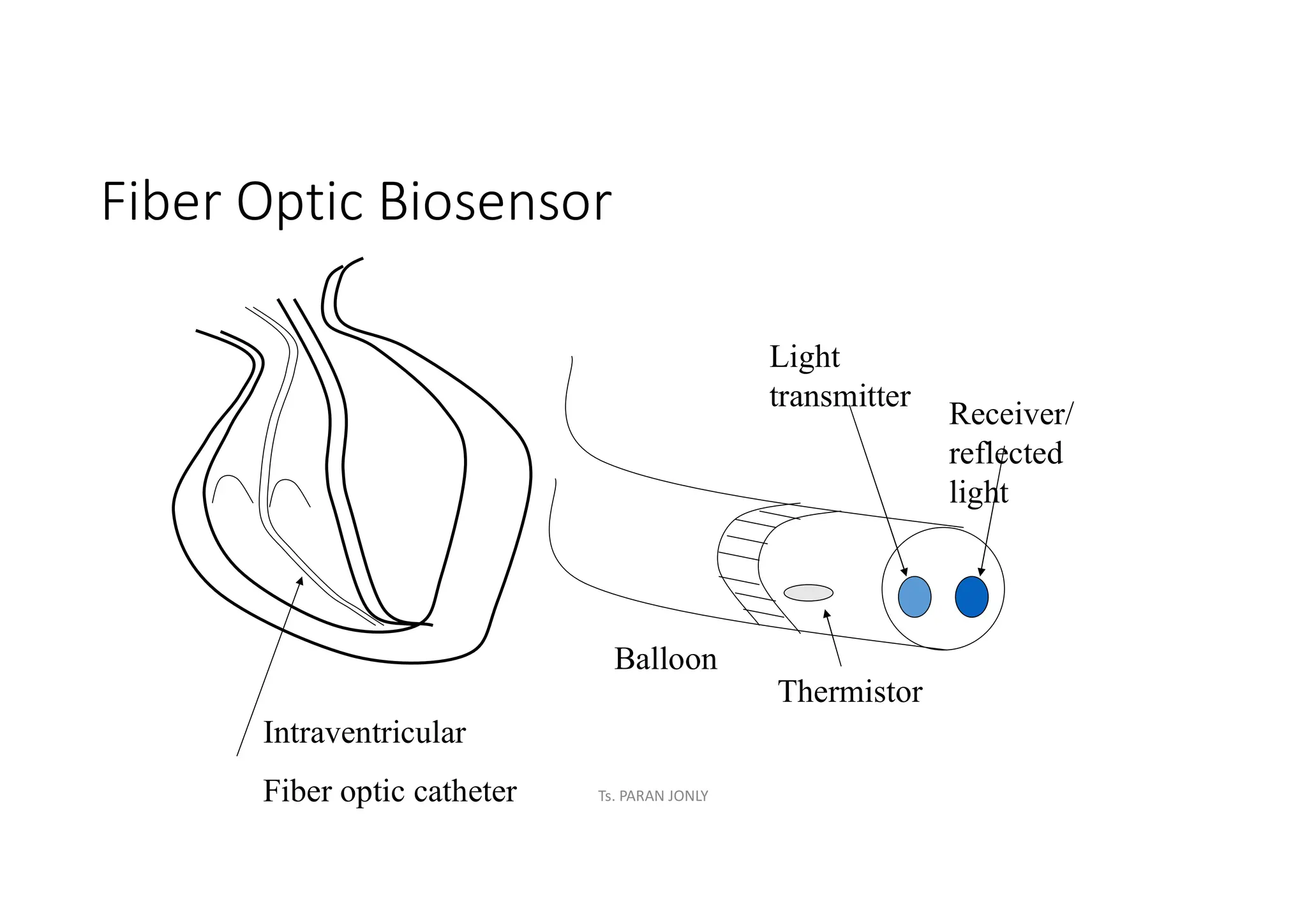 Fiber Optic Biosensor
Balloon
Thermistor
Light
transmitter
Receiver/
reflected
light
Intraventricular
Fiber optic catheter Ts. PARAN JONLY
 