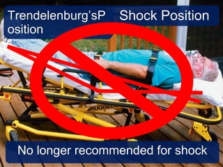 Trendelenburg’sP
osition
Shock Position
No longer recommended for shock
 