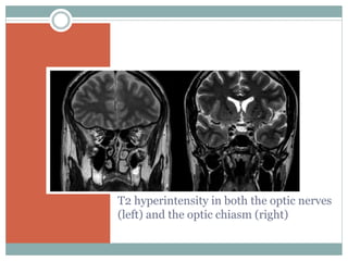 T2 hyperintensity in both the optic nerves
(left) and the optic chiasm (right)
 