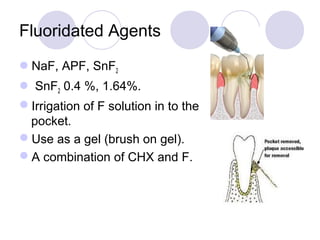 Fluoridated Agents
NaF, APF, SnF2
 SnF2 0.4 %, 1.64%.
Irrigation of F solution in to the
pocket.
Use as a gel (brush on gel).
A combination of CHX and F.
 