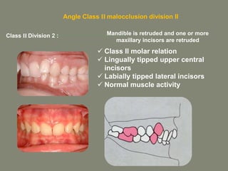 classification of malocclusion | PPTX