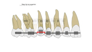 basics of orthodontic force system | PPTX