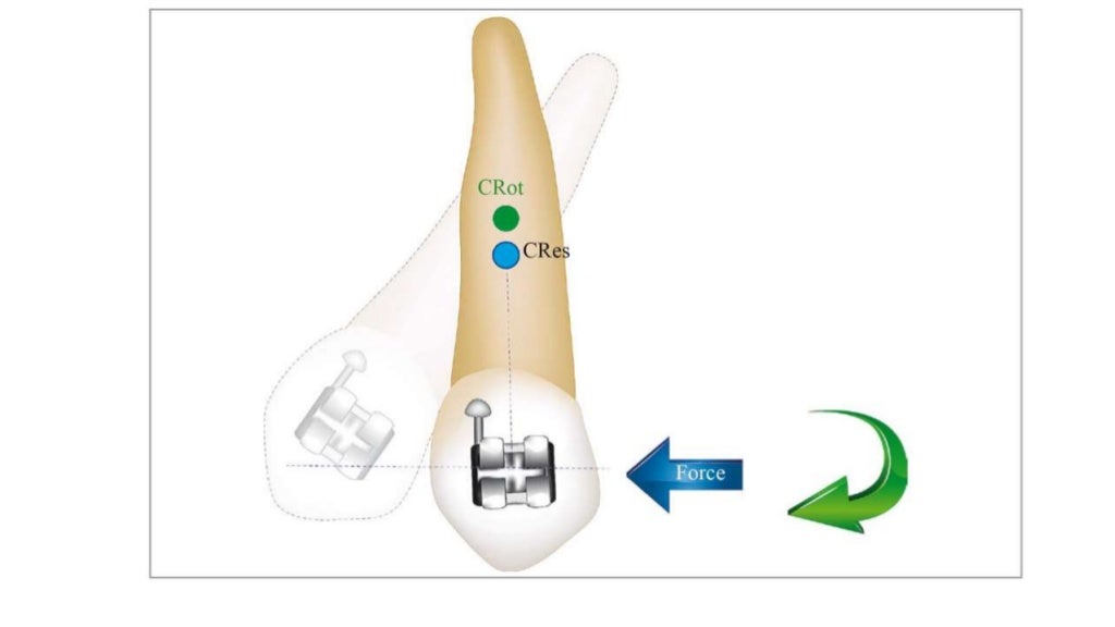 basics of orthodontic force system