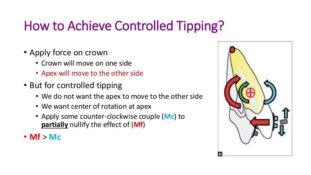 basics of orthodontic force system