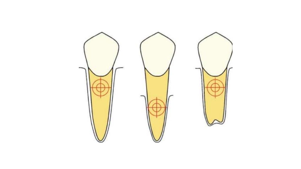 basics of orthodontic force system