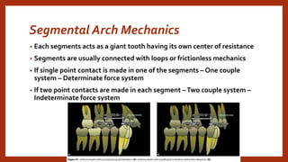 Segmental Arch Mechanics
• Each segments acts as a giant tooth having its own center of resistance
• Segments are usually connected with loops or frictionless mechanics
• If single point contact is made in one of the segments – One couple
system – Determinate force system
• If two point contacts are made in each segment –Two couple system –
Indeterminate force system
 