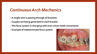 Continuous Arch Mechanics
• A single wire is passing through all brackets
• Couples are being generated in each bracket
• The force system is changing with even minor tooth movements
• Example of indeterminate force system
 