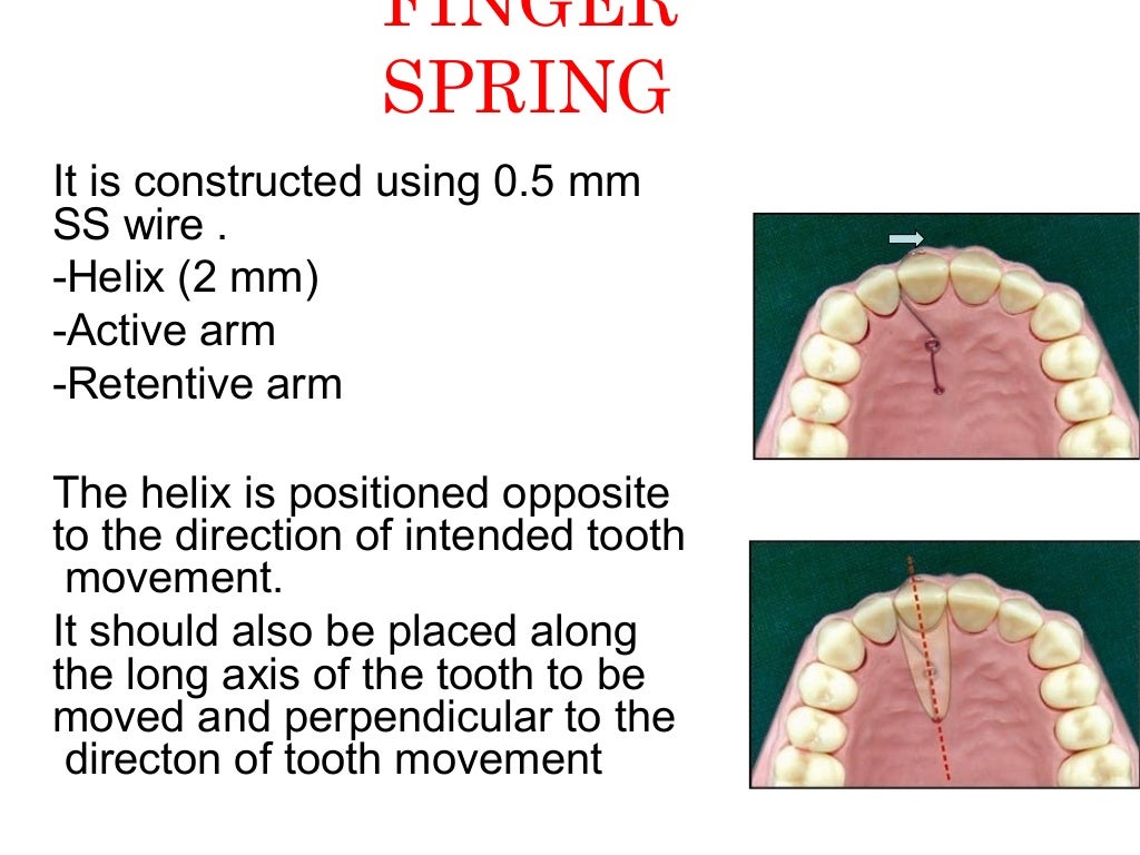 removable orthodontic appliances