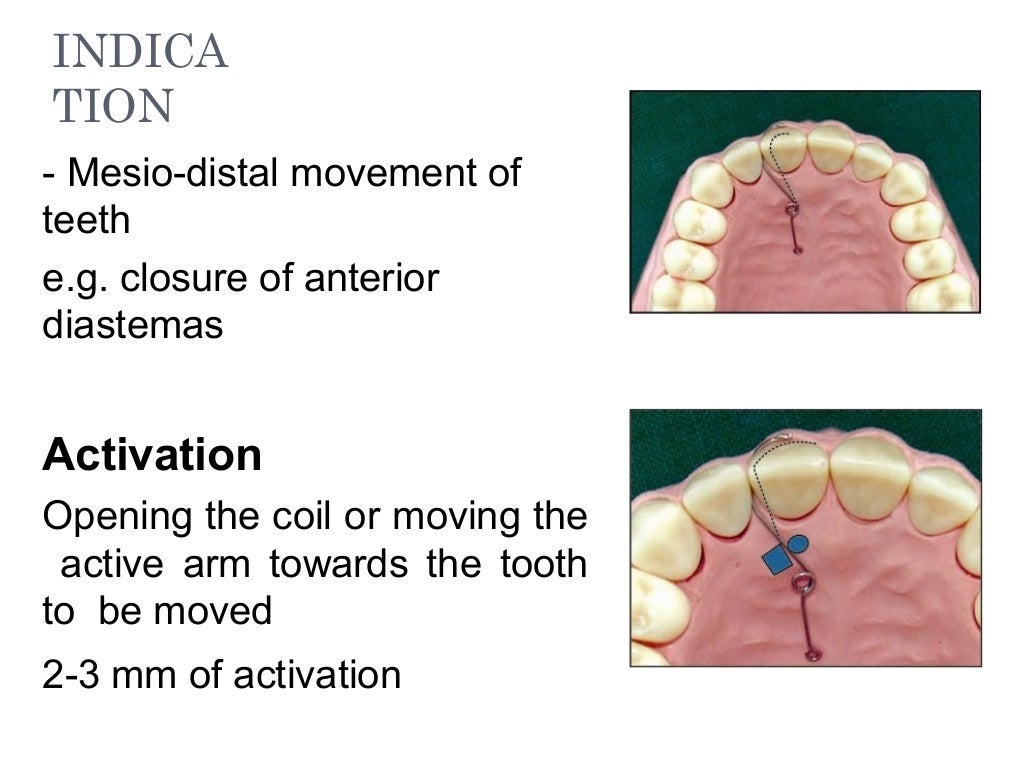 removable orthodontic appliances