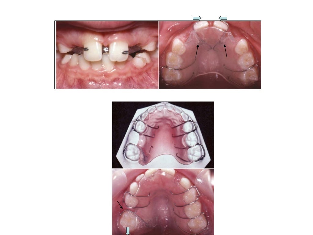 removable orthodontic appliances