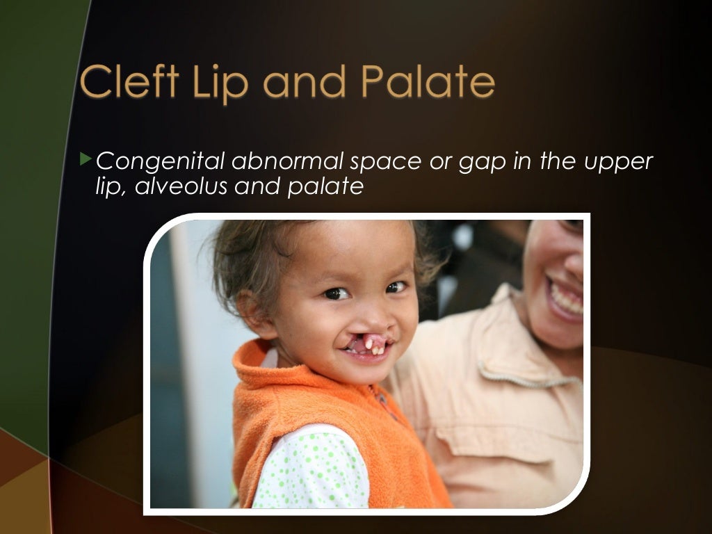 Cleft lip and palate Introduction and Orthodontic Considerations