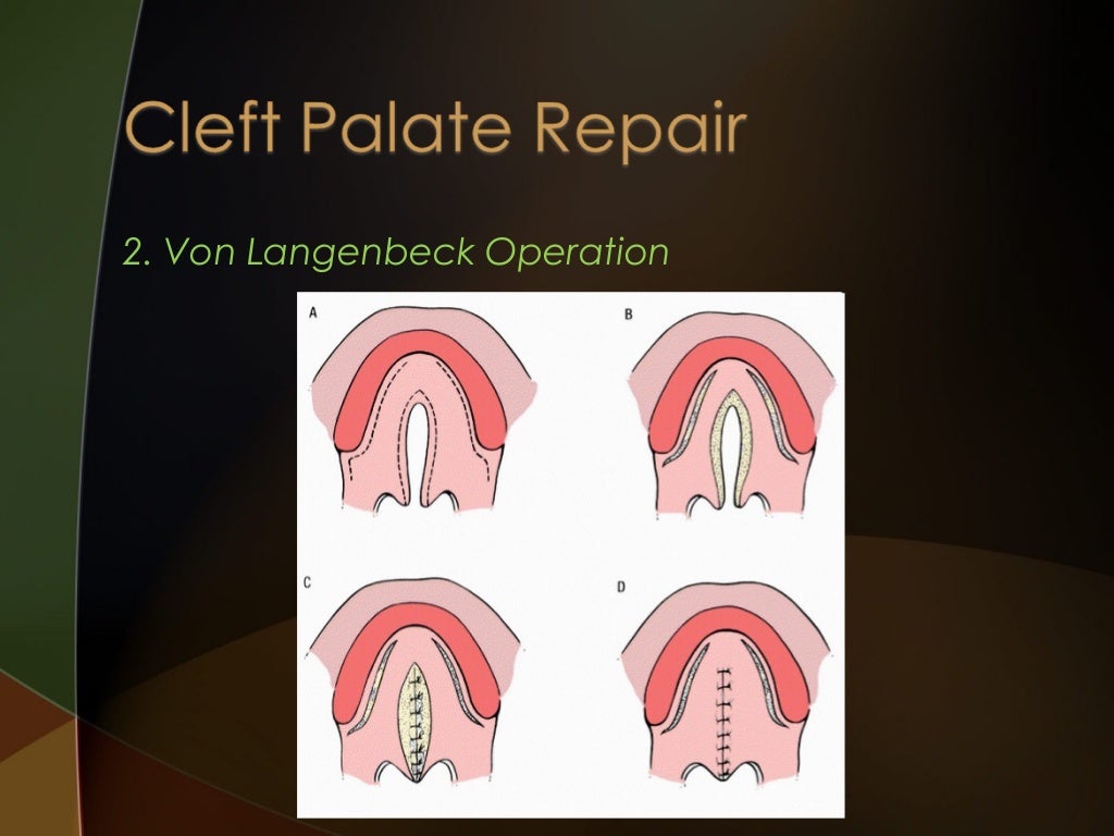 Cleft lip and palate Introduction and Orthodontic Considerations