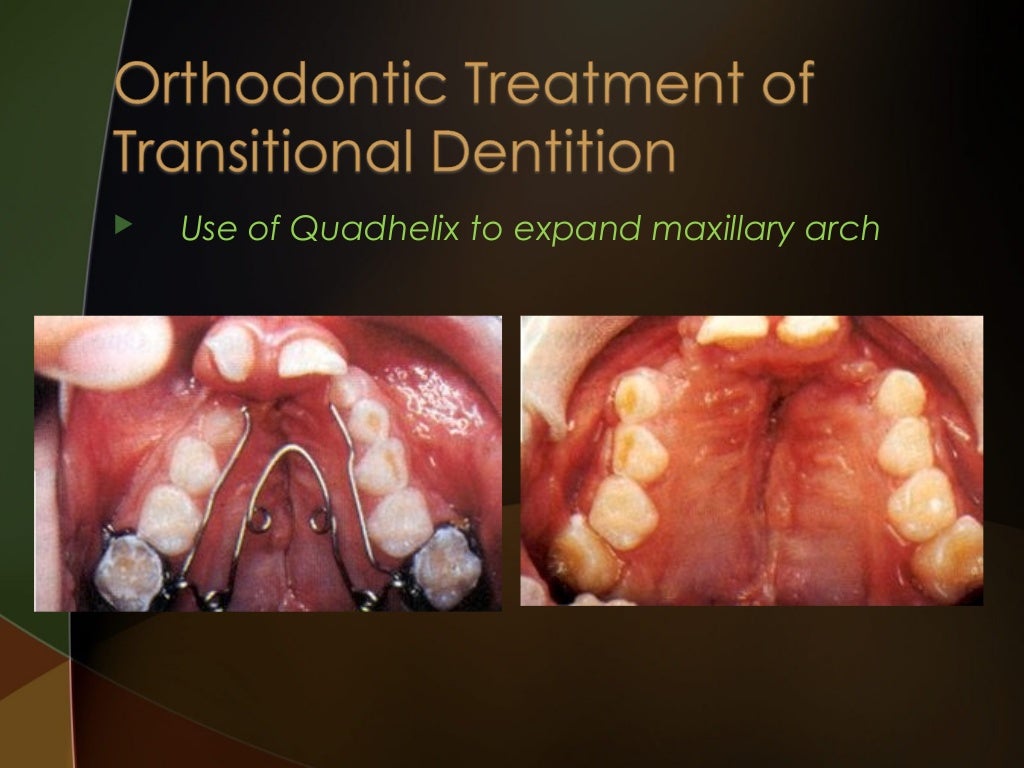 Cleft lip and palate Introduction and Orthodontic Considerations