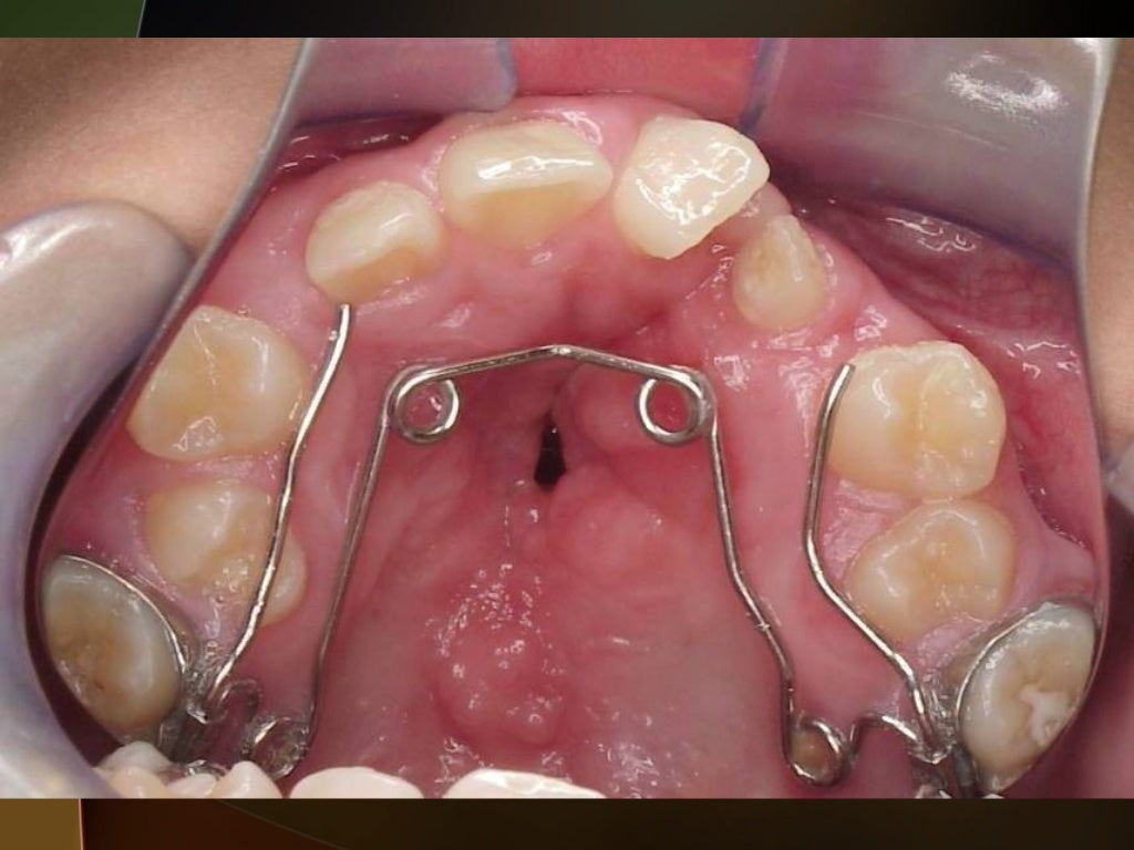 Cleft lip and palate Introduction and Orthodontic Considerations
