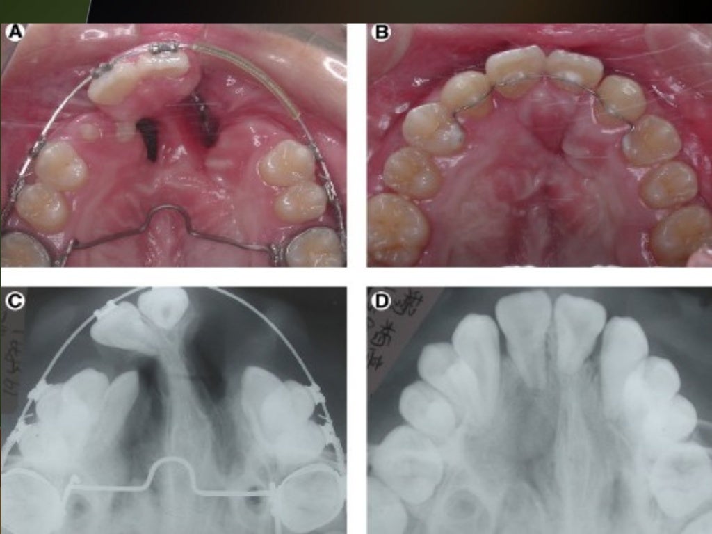 Cleft lip and palate Introduction and Orthodontic Considerations