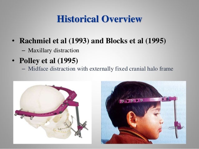 surgical interventions in orthodontics the application of a cranial halo is a form of