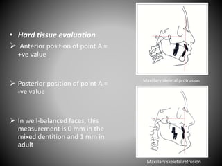 • Hard tissue evaluation
 Anterior position of point A =
+ve value
 Posterior position of point A =
-ve value
 In well-balanced faces, this
measurement is 0 mm in the
mixed dentition and 1 mm in
adult
Maxillary skeletal protrusion
Maxillary skeletal retrusion
 