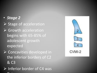 • Stage 2
 Stage of acceleration
 Growth acceleration
begins with 65-85% of
adolescent growth
expected
 Concavities developed in
the inferior borders of C2
& C3
 Inferior border of C4 was
 