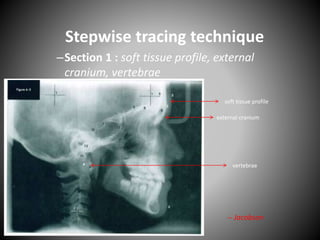 Stepwise tracing technique
–Section 1 : soft tissue profile, external
cranium, vertebrae
soft tissue profile
external cranium
vertebrae
-- Jacobson
 
